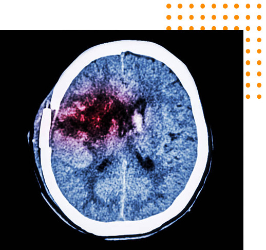 Types of Cerebral Stroke Types of Cerebral Stroke