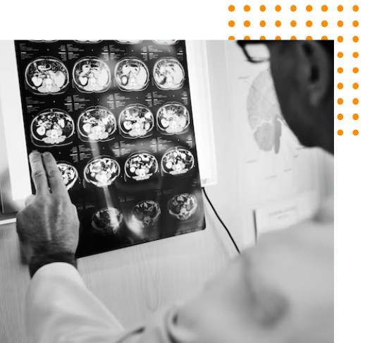 brain-stroke-proc-img brain-stroke-procedure-img