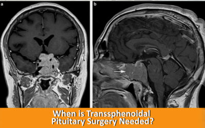 When is Transsphenoidal Pituitary Surgery Needed?