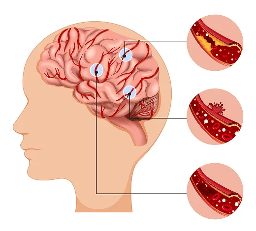 Why Choose a Craniotomy Neurosurgeon in Kolkata? Why Choose a Craniotomy Neurosurgeon in Kolkata?
