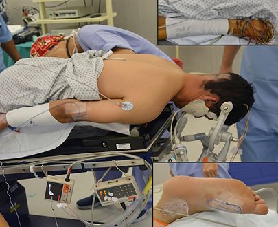 DREZ Lesioning Procedure | Dr Rohit Mishra