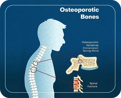 Causes of Vertebral Compression