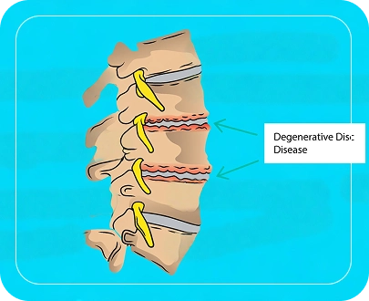 Types of Spine Degeneration Types of Spine Degeneration