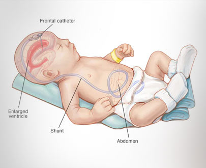 Hydrocephalus Surgeon in Kolkata
