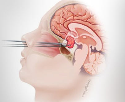 Transsphenoidal Surgeon in Kolkata | Dr Rohit Mishra