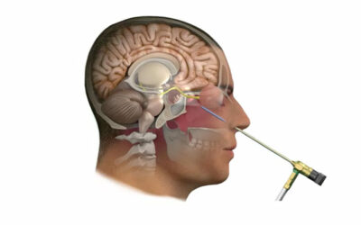 Understanding Skull Base Tumour Surgery Challenges and Advances in Kolkata