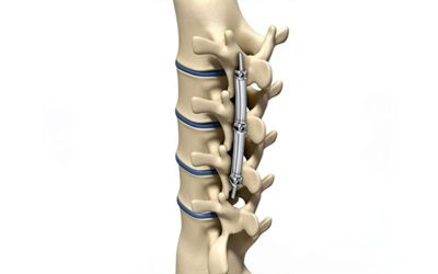 When to Consult a Spine Fixation Surgeon : Recognising the Signs